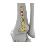Itval Distal Posterior Tibial Kilitli Plak