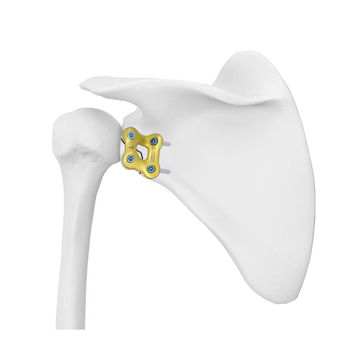Glenoid Kilit Plakası