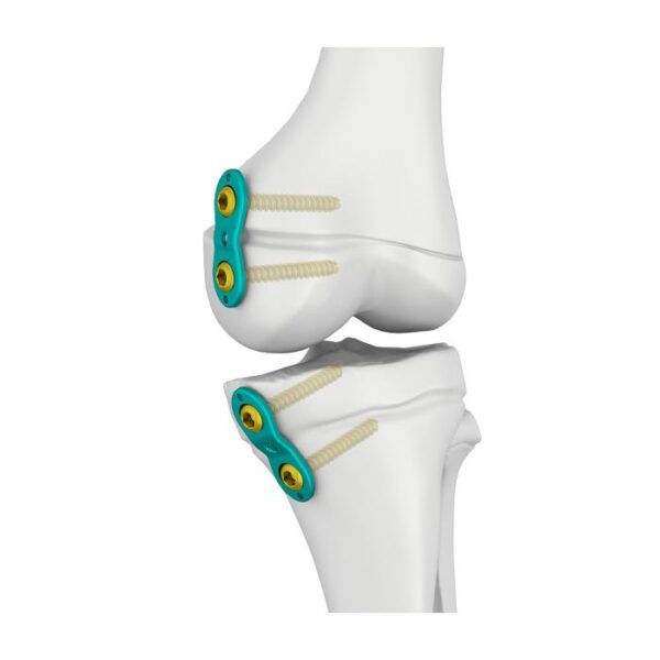3.0/4.5mm Epifiz Plağı