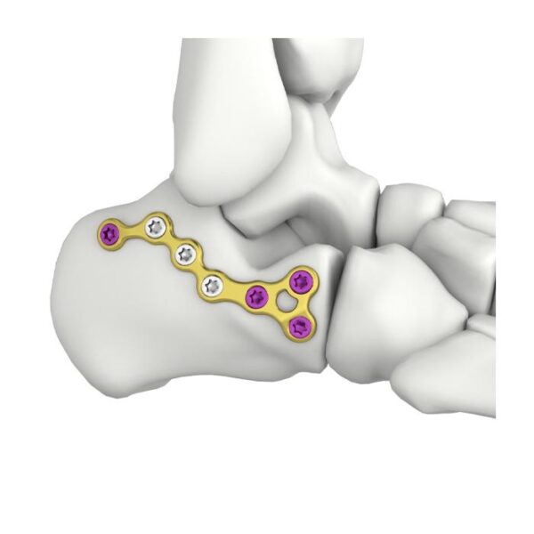 Itval Ön Geçici Calcaneal Kilit Plakası