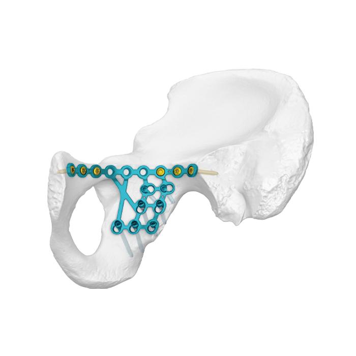 Düşük Posterior Sütun İntra-arkuat Hattı Kilitlenme Plakası