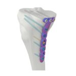 VAL Proksimal Medial Tibia Kilitli Plakası