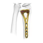 Distal Radius Kilitli Plak I