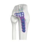 VAL Proksimal Lateral Tibial DR Kilitli Plaka
