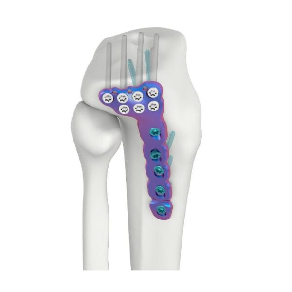 VAL Proksimal Lateral Tibial DR Kilitli Plaka