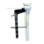 Lateral Tibial Baş Dikizleme Kilitli Plaka Ⅱ