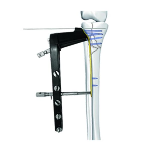 Lateral Tibial Baş Dikizleme Kilitli Plaka Ⅱ