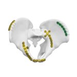 Anterior Sakroiliak Eklem Plağı