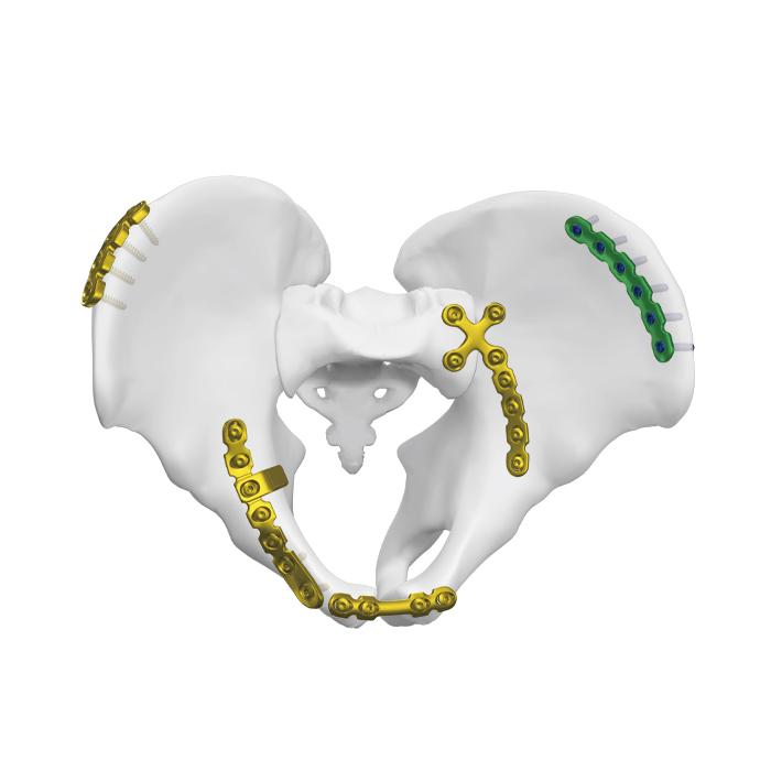 Anterior Sakroiliak Eklem Plağı