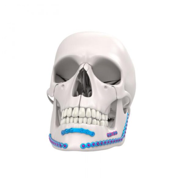 Mandibula Fiksasyon Sistemi