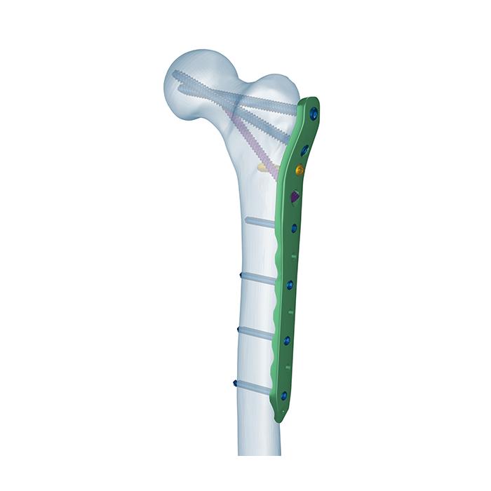 Proksimal Femoral Kilitli Plak