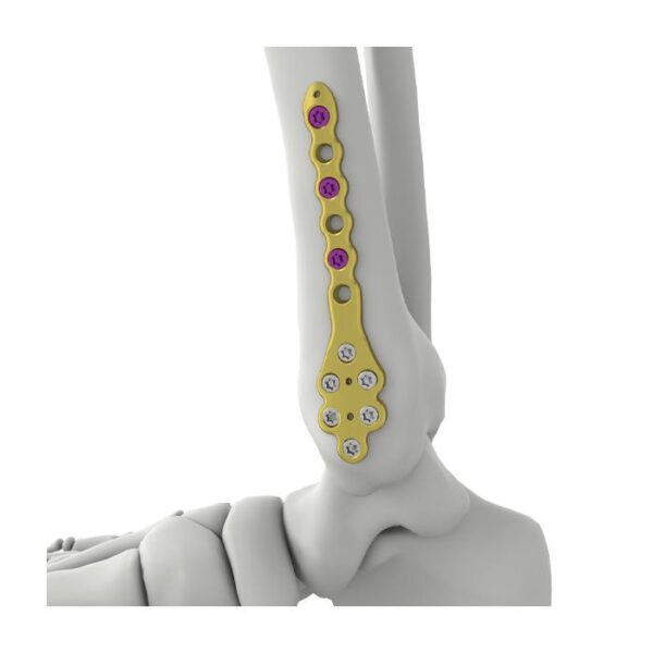 Itval Distal Medial Tibial Kilitli Plaka