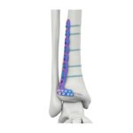 VAL Distal Anterior Lateral Tibial Kilitlenme Plağı