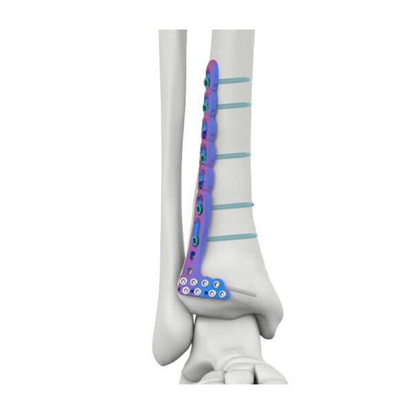 VAL Distal Anterior Lateral Tibial Kilitlenme Plağı