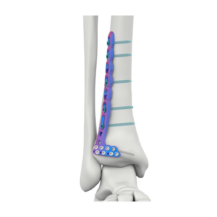 VAL Distal Anterior Lateral Tibial Kilitlenme Plağı