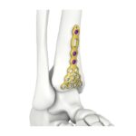 Itval Distal Anterior Tibial Kilitli Plaka