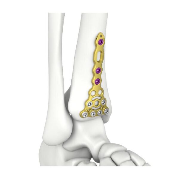 Itval Distal Anterior Tibial Kilitli Plaka