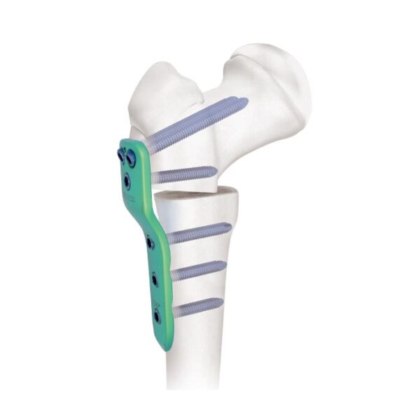 2.7/3.5/5.0mm Pediatrik Kalça Kilitli Plak