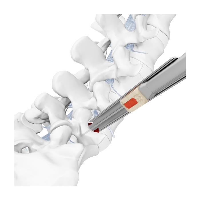 Endo LIF Endoskopik Transforaminal Kafes