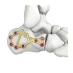 İtval Calcaneal Kilitleyici Plaka