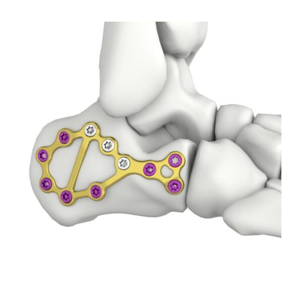 İtval Calcaneal Kilitleyici Plaka