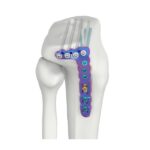 VAL Proksimal Lateral Tibial SR Kilitli Plak Düşük Büküm