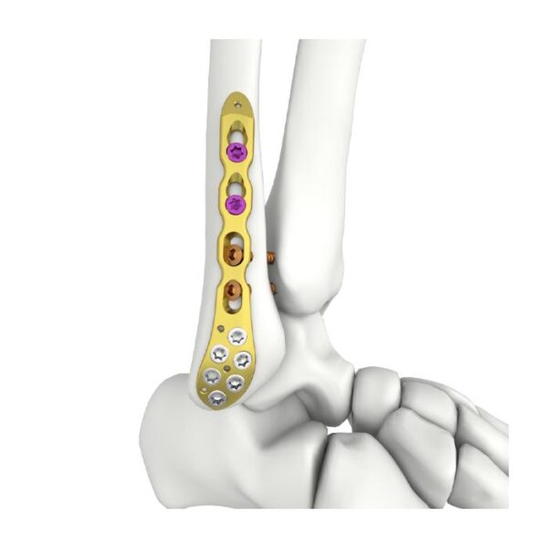 Itval Distal Lateral Fibular Locking Plate (Itval Distal Lateral Fibular Kilitli Plak)