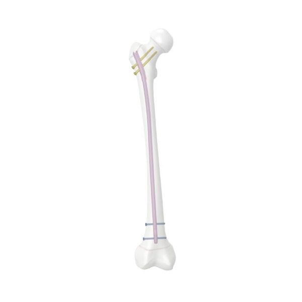 Ergen femoral çivi sistemi