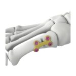 Itval İlk Metatarsal Osteotomi Kilitli Plaka